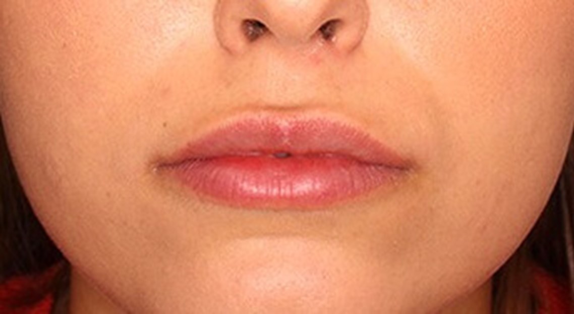 Hyaluronzuur op de lippen: een doeltreffende werking tegen