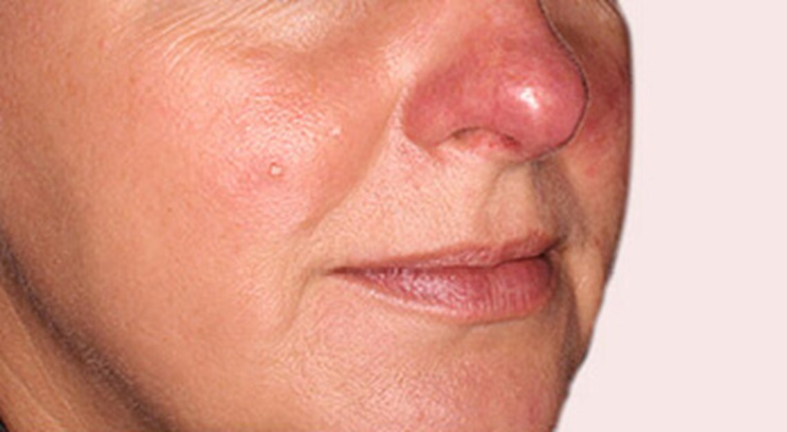overschot Bijlage jury Rosacea - Huidaandoening in het gezicht | Velthuis kliniek