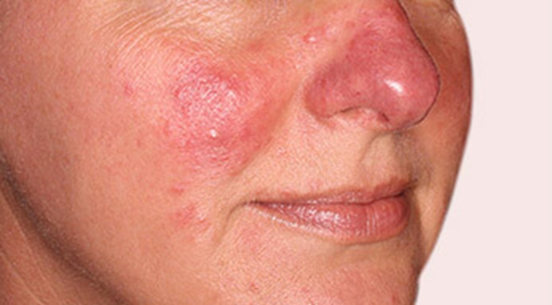 Speel inhoud Ontevreden Rosacea - Huidaandoening in het gezicht | Velthuis kliniek