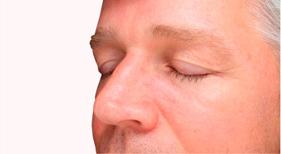 tegenkomen Sijpelen doe alstublieft niet Rosacea - Huidaandoening in het gezicht | Velthuis kliniek