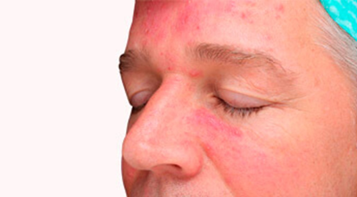 Rosacea Huidaandoening in het gezicht | Velthuis kliniek