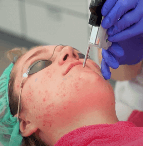 plakband Vruchtbaar erosie Acne behandeling | Velthuis kliniek