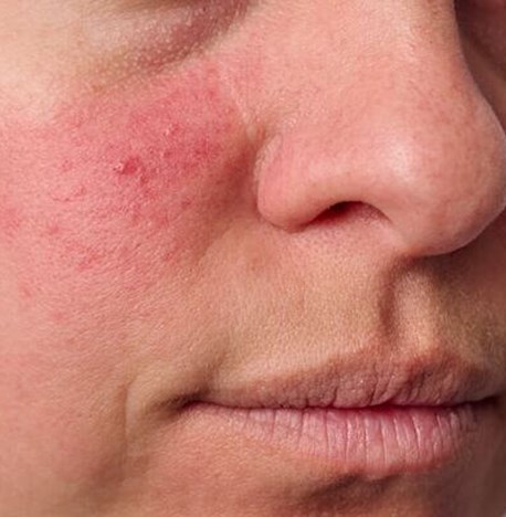 een vergoeding tevredenheid Uitgraving Rosacea - Huidaandoening in het gezicht | Velthuis kliniek